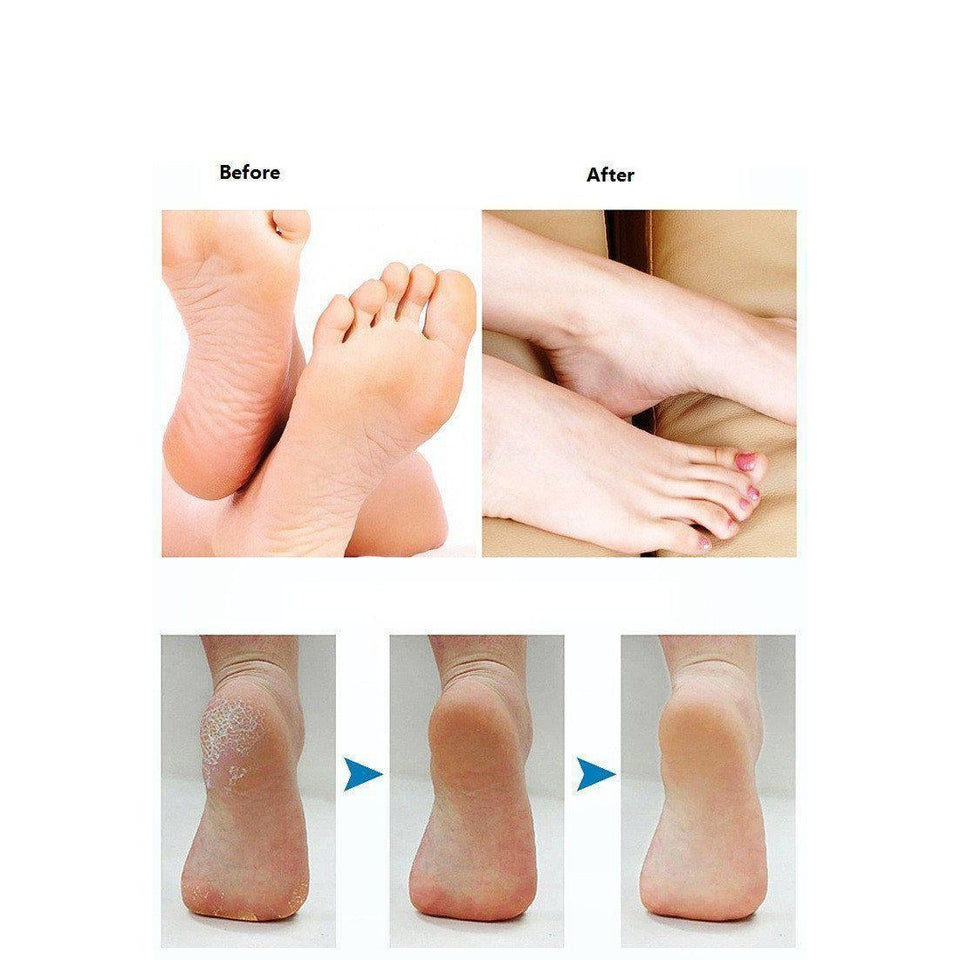 SkinSmooth™ Callus Remover Foot Care-Sulit Promos